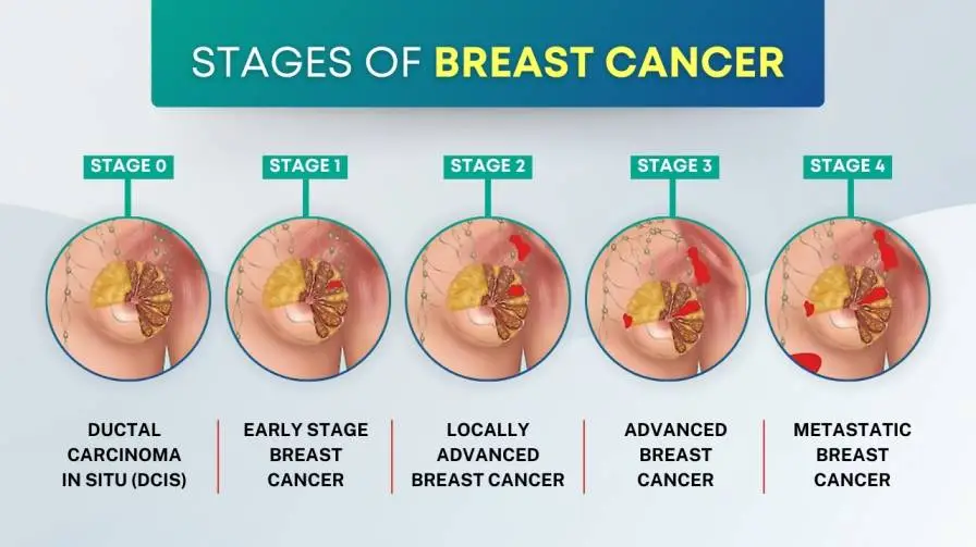 The Stages Of Breast Cancer Kolhapur Cancer Centre The Stages Of Breast Cancer Kolhapur Cancer Centre